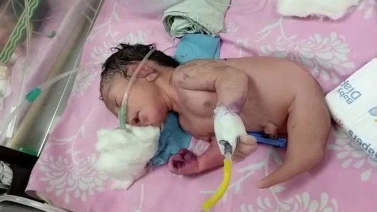 El bebé nació en la India y se encuentra en condición estable.
