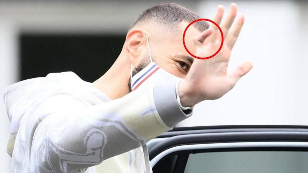 Karim Benzema tiene el dedo meñique de la mano derecha fracturado.