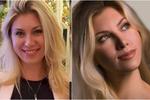 “Mis ojos no se cierran y no puedo sonreír”: reina de belleza de Rusia sufre tras cirugía fallida
