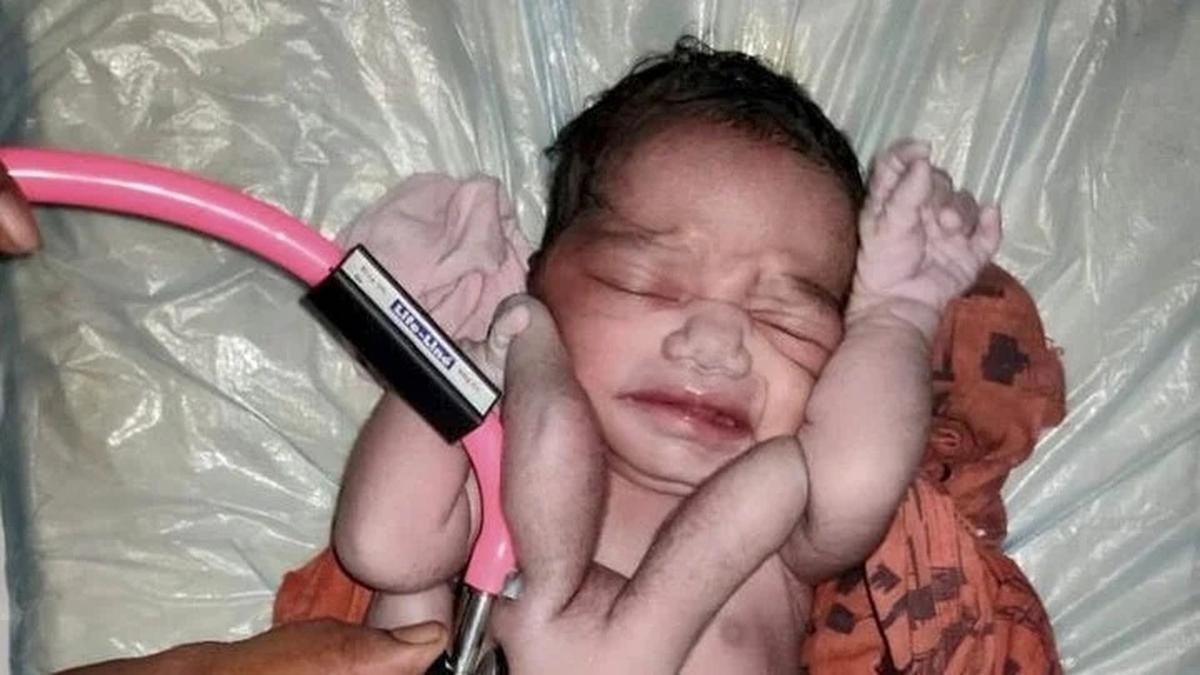El niño con cuatro brazos también nació en la India.